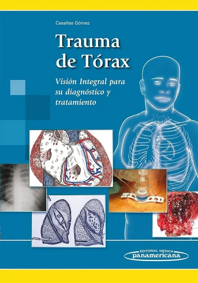 CASALLAS:Trauma de Torax